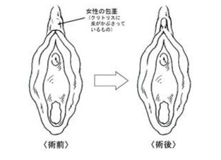 千葉クリトリス包茎