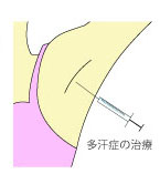 千葉多汗症ボトックス