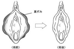 小陰唇黒ずみ