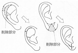 千葉裂けた耳たぶ治す