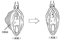 小陰唇大きい