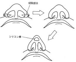 千葉鼻高くする