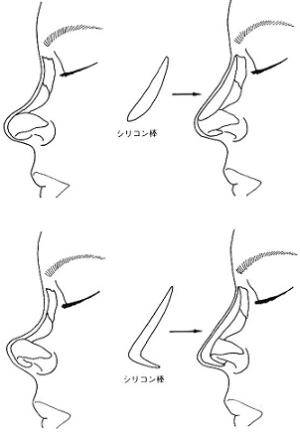 千葉鼻プロテーゼ挿入