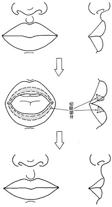 唇小さくする手術