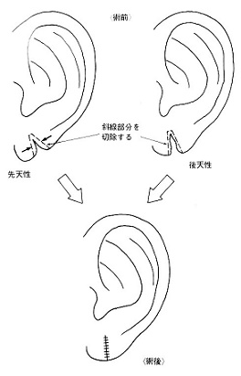 裂けた耳たぶ