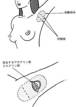 千葉ワキガ手術