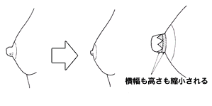 千葉乳頭縮小