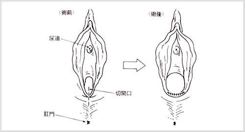 千葉処女膜再生