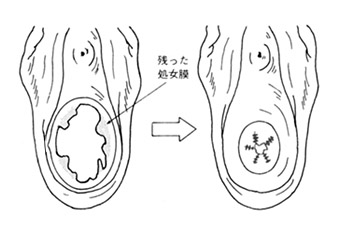 処女膜再生サンライズ美容外科