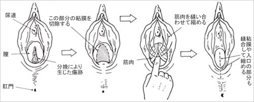 千葉膣縮小