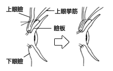 千葉二重切開