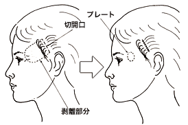 千葉こめかみくぼみ