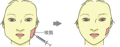 千葉小顔注射