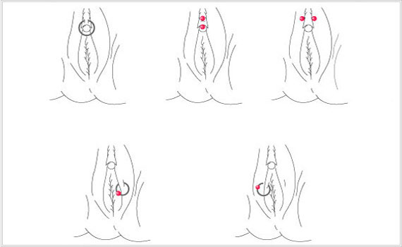 クリトリスピアス 性器ピアス・穴あけ・費用/千葉 横浜サンライズ美容外科