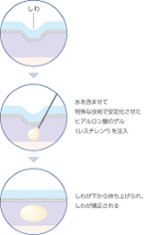 千葉レスチレンヒアルロン酸