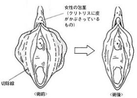 美しい女性器 サンライズ美容外科