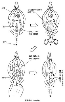 美しい女性器 サンライズ美容外科